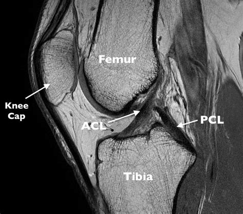 acl tear diagnostic test mri|grade 2 acl tear mri.